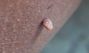 To remove one or two particular moles you can use the frankincense oil with the olive oil. Vaginal Skin Tags Causes Diagnosis And How To Remove Them