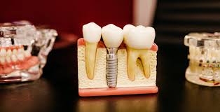 Maybe you would like to learn more about one of these? How To Fix A Broken Tooth At Home Advanced Indiana