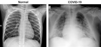 Optimierung Der Krankenhausdiagnostik Im Bereich Der Pneumonie Mithilfe Von Cnns Informatik Aktuell