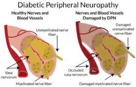 Image result for Peripheral Neuropathy