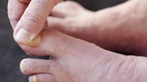 Image result for mykoza nehtů