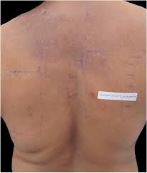 Allergic Contact Dermatitis By Shampoo Components A Descriptive Analysis Of 20 Cases