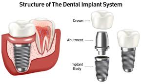 Image result for dental implant