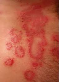 9 Thigh Rash Ideas Rashes Inner Thigh Rash Rash Causes