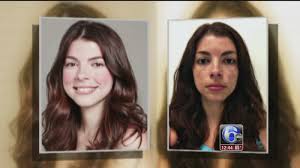 Maybe you would like to learn more about one of these? Sunburn Leaves Woman With Permanent Dark Facial Marks 6abc Philadelphia