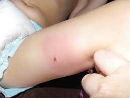 The following measures may be useful to prevent ant bites: Home Remedies For Ant Bites Healthy Tips