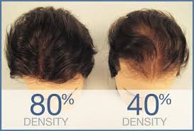 This has proven to increase hair growth and density in many. 10 Hair Density Ideas Hair Density Hair Loss Women Help Hair Loss