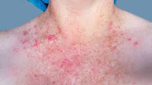 Image result for scabies symptoms