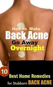 We did not find results for: Top 10 Home Remedies To Get Rid Of Back And Shoulder Acne Fast Allmondo Lifestyle Body Acne Remedies Back Acne Treatment Back Acne Remedies