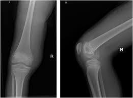 Medial in anatomy means toward the midline of the body, as opposed to lateral, or toward the sides of the body. Hoffa S Fracture Of The Medial Femoral Condyle In A Child Treated With Open Reduction And Internal Fixation A Case Report Sciencedirect