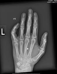It is typically caused by abnormal growth and development of the small bones of the finger. What Happens When You Break Your Pinky Finger Album On Imgur