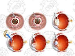 Image result for Cataract Extraction
