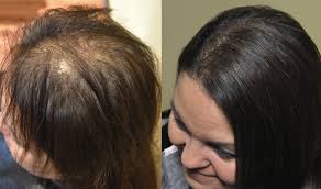 At allusions, we specialize in women's hair loss solutions for those who are experiencing thinning hair, extreme breakage and/or excessive shedding. 9 Thinning Hair Solutions Ideas