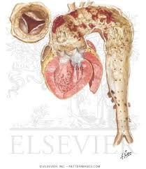 Image result for Cardiovascular Syphilis