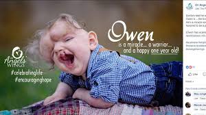 Missouri boy celebrates his first birthday without a skull