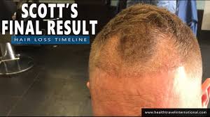 Having lost hair due to stress over the pandemic, both erica (left) and aggie added hair extensions and color to revive. Fue Hair Transplant Final 21 Month Result Timeline Hair Loss Treatment Baldness For Men 2016 Youtube