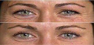 Furthermore, acetylcholine release from the presynaptic membranes of muscarinicnerve synapses is blocked. Les Injections De Botox Ou Toxine Botulique En Esthetique Avis Afme Afme