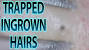 Swollen Ingrown Eyebrow Hair