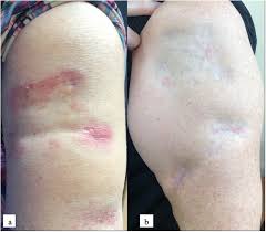 Image result for Panniculitis