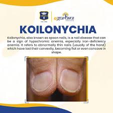 Image result for Koilonychia feet