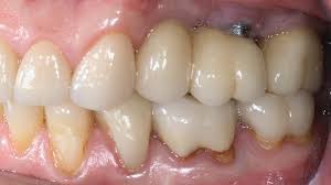 When you are getting a gold tooth, you are paying for a traditional dental implant (titanium or zirconia) and a gold dental crown. How Titanium Implants Act As Antennas For Electromagnetic Fields Dna