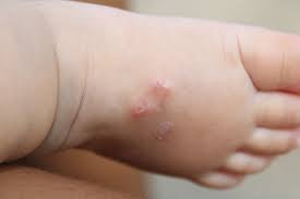 Image result for scabies symptoms