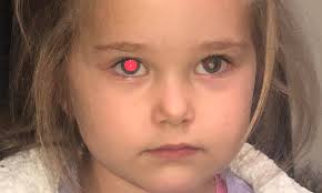 Cancer formation occurs when both copies of the rb1 gene in the retina are inactive. Queensland Mother Urges Parents To Take Flash Photos After An Image Showed Her Daughter S Cancer Daily Mail Online