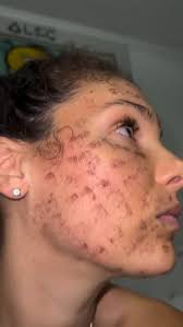 Let’s talk about the truth behind RF Microneedling…, When done right, it’s  one of the most powerful skin-tightening + collagen-boosting treatments  available. But when done wrong? It can leave burns, ...