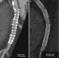 Why do metal detectors go off? Imaging Of Coronary Revascularization Stent And Cabg Springerlink