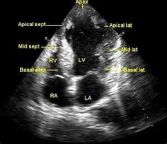 Flashcard Echocardiography Anatomy Location Quizlet Cardiac Sonography Ultrasound Technician Sonography Student