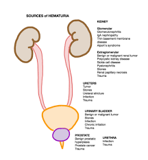 • causes of asymptomatic gross hematuria (acute cystitis, bladder cancer, benign prostatic hyperplasia, nephrolithiasis, benign essential urinary mid tract obstruction syndrome 1. Hematuria Wikipedia