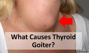 Image result for Goiter