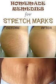 Bio Oil White Stretch Marks Before And After 5 Effective Home Remedies For Stretch Marks Stretch Mark Remedies Stretch Marks Stretch Marks Removal Diy