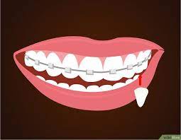 How To Make Vampire Fangs If You Have Braces 12 Steps Vampire Fangs Vampire Halloween Fangs