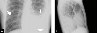 Ap upright and lateral views of the. Racgp An Uncommon Cause For A Unilateral Pleural Effusion Rheumatoid Pleuritis