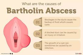 Image result for Bartholin's gland abscess