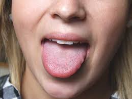 Image result for brown tongue symptoms