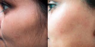 Get the latest packages today! Laser Hair Removal Kuala Lumpur Malaysia Cost Reviews Benefits Nexus Cllinic