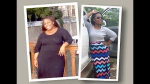 gastric sleeve before and after