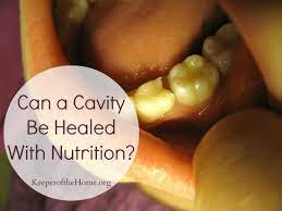 Can A Cavity Be Healed With Nutrition Keeper Of The Home Heal Cavities Cavity Cure Oral Health Care