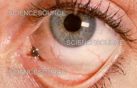 Image result for conjunctival melanoma