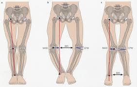 Beinachsenkorrektur Umstellungsosteotomie Ortho Clinics Webseite