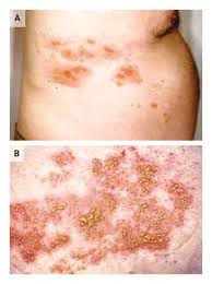 Image result for Varicella zoster on human skin