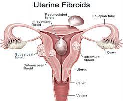 Fibroids are benign tumors that form in the uterus. Fibroids Philippe De Rosnay