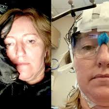 'It took the rug right out from under my life': Milestone ME/CFS study  begins to explain disease, but will it lead to treatments?