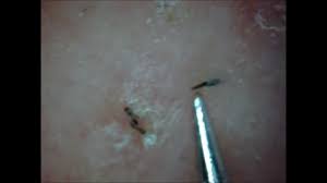 Sometimes you can see a hair trapped under the skin. Tweezing Out Ingrown Hair Youtube