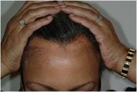 Garlic is a very commonly used home remedy in the treatment of alopecia areata in india and even in the rest of the world. Current And Emerging Treatment Strategies For Hair Loss In Women Of Color Sciencedirect