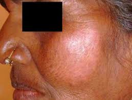 When compared to tuberculoid or lepromatous forms, it is of intermediate severity. Leprosy Dermnet Nz