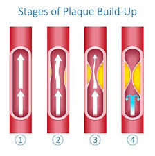 Große auswahl an clog holz. 24 Carotid Artery Ideas Carotid Artery Arteries Clogged Arteries