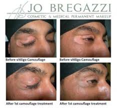 Start getting your skin color back in as little as 4 days! Medical Tattooing Scar Camouflage Vitiligo Camouflage Areola Tattooing